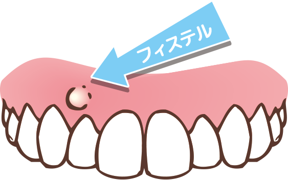 フィステル 歯茎に膿が出たらすぐに歯医者に行く理由。歯の健康を保つことは究極の節約です